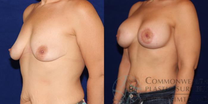 Before & After Breast Augmentation Case 77 View #2 View in Lexington & London, KY
