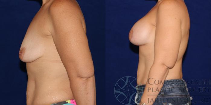 Before & After Breast Augmentation Case 77 View #3 View in Lexington & London, KY