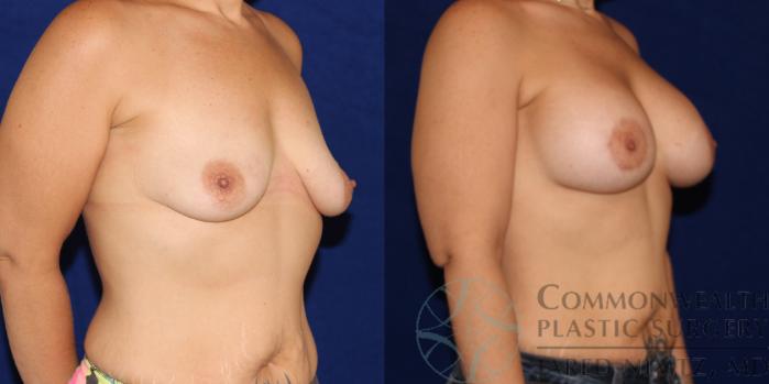 Before & After Breast Augmentation Case 77 View #4 View in Lexington & London, KY