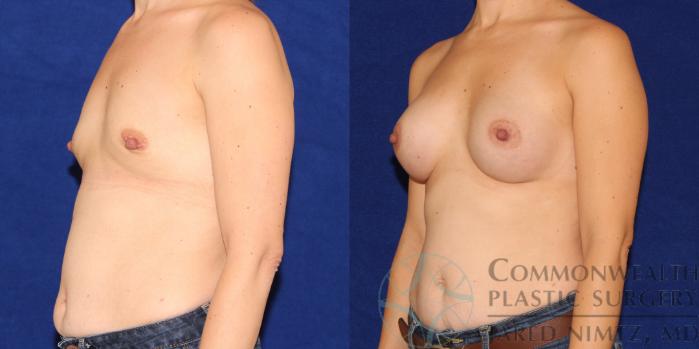 Before & After Breast Augmentation Case 86 View #2 View in Lexington & London, KY