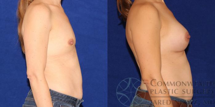Before & After Breast Augmentation Case 86 View #3 View in Lexington & London, KY