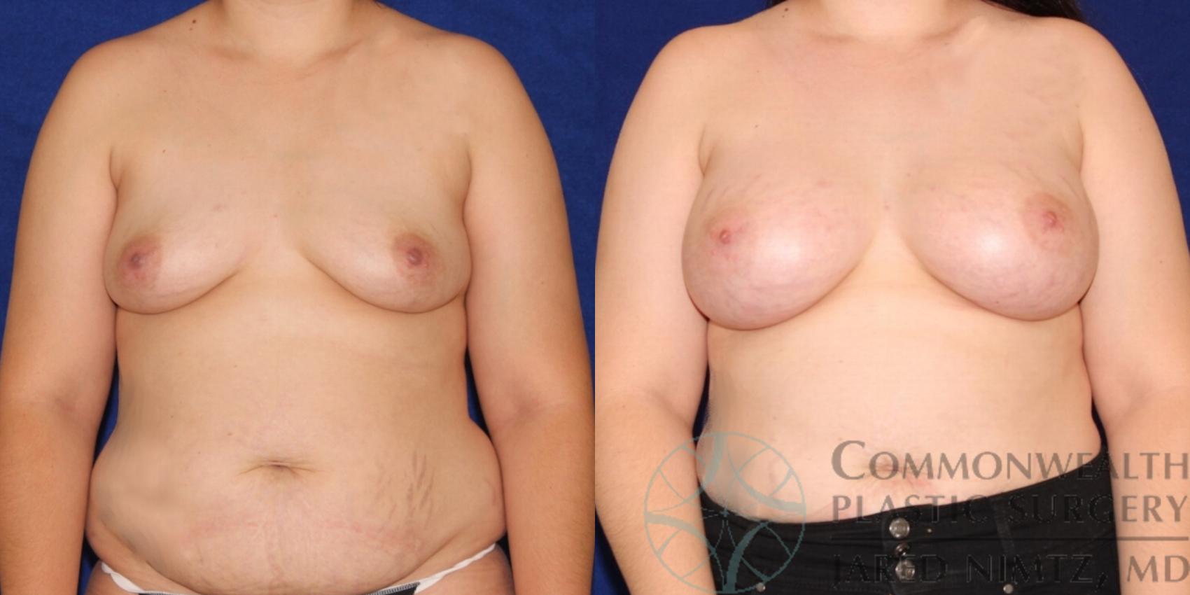 Before & After Breast Augmentation Case 90 View #1 View in Lexington & London, KY