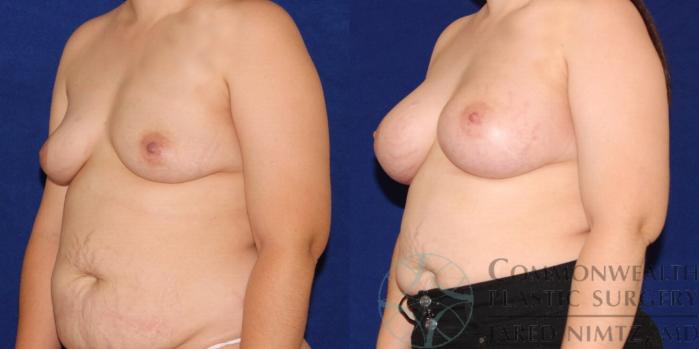 Before & After Breast Augmentation Case 90 View #2 View in Lexington & London, KY