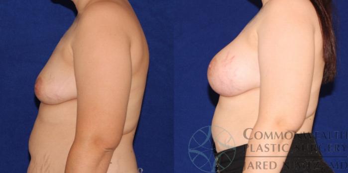Before & After Breast Augmentation Case 90 View #3 View in Lexington & London, KY