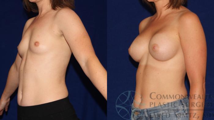 Before & After Breast Augmentation Case 91 Left Oblique View in Lexington & London, KY