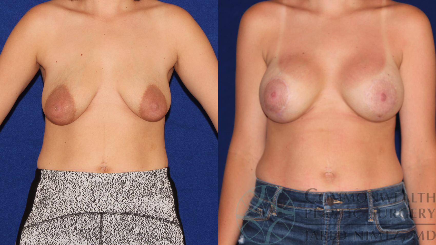 Before & After Breast Augmentation Case 97 Front View in Lexington & London, KY