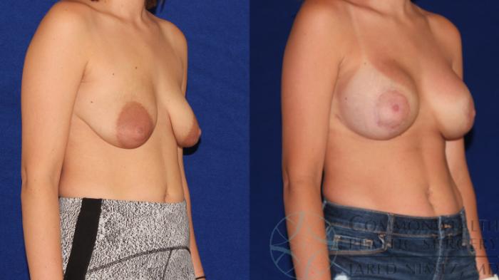 Before & After Breast Augmentation Case 97 Right Oblique View in Lexington & London, KY