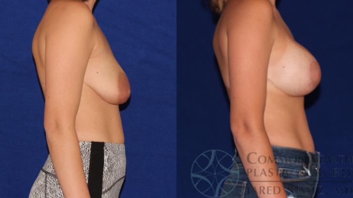 Before & After Breast Augmentation Case 97 Right Side View in Lexington & London, KY