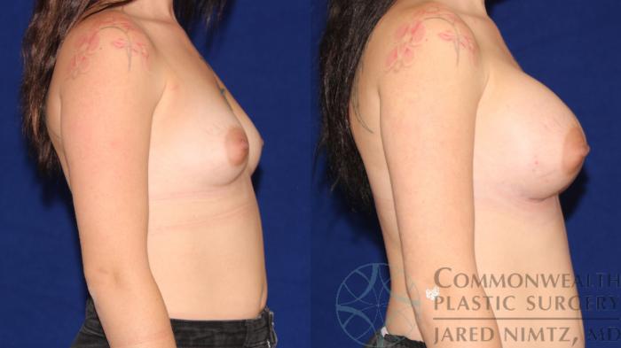 Before & After Breast Augmentation Case 99 Right Side View in Lexington & London, KY