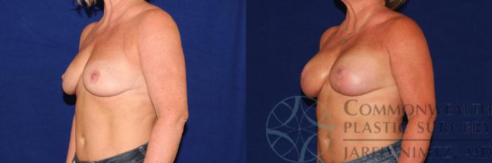 Before & After Breast Lift Case 110 Left Oblique View in Lexington & London, KY