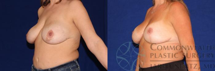 Before & After Breast Lift Case 111 Left Oblique View in Lexington & London, KY