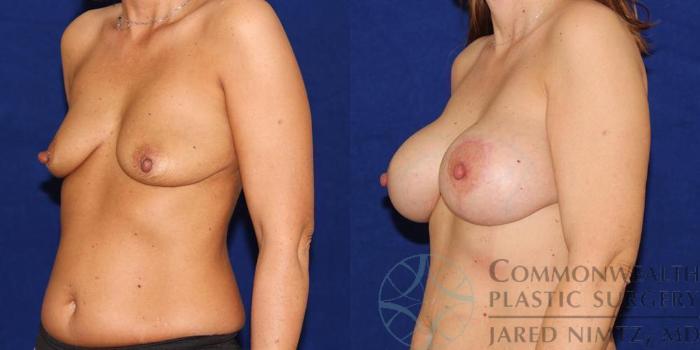 Before & After Breast Lift Case 55 View #2 View in Lexington & London, KY