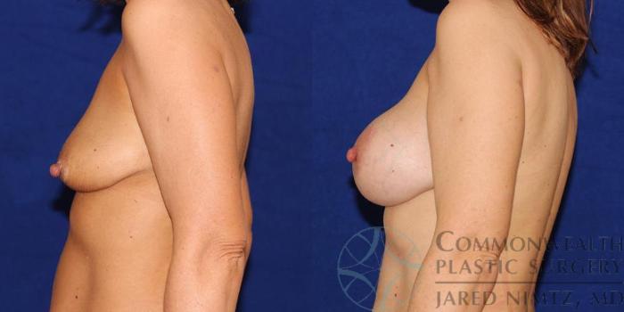 Before & After Breast Augmentation Case 55 View #3 View in Lexington & London, KY