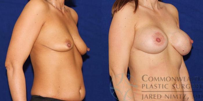Before & After Breast Augmentation Case 55 View #4 View in Lexington & London, KY