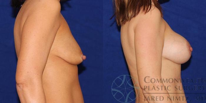 Before & After Breast Lift Case 55 View #5 View in Lexington & London, KY