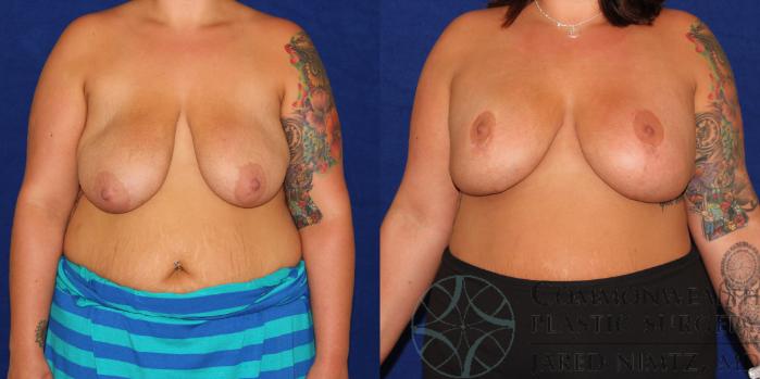 Before & After Breast Lift Case 78 View #1 View in Lexington & London, KY