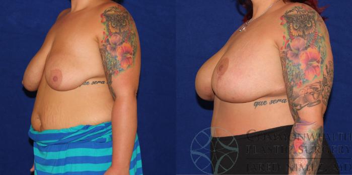 Before & After Breast Lift Case 78 View #2 View in Lexington & London, KY
