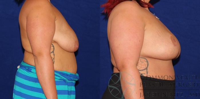 Before & After Breast Lift Case 78 View #3 View in Lexington & London, KY