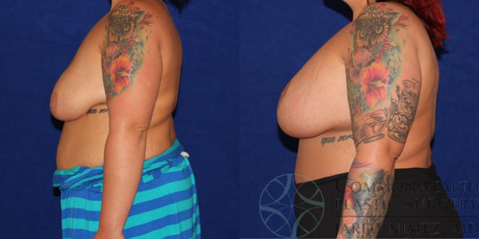 Before & After Breast Lift Case 78 View #4 View in Lexington & London, KY