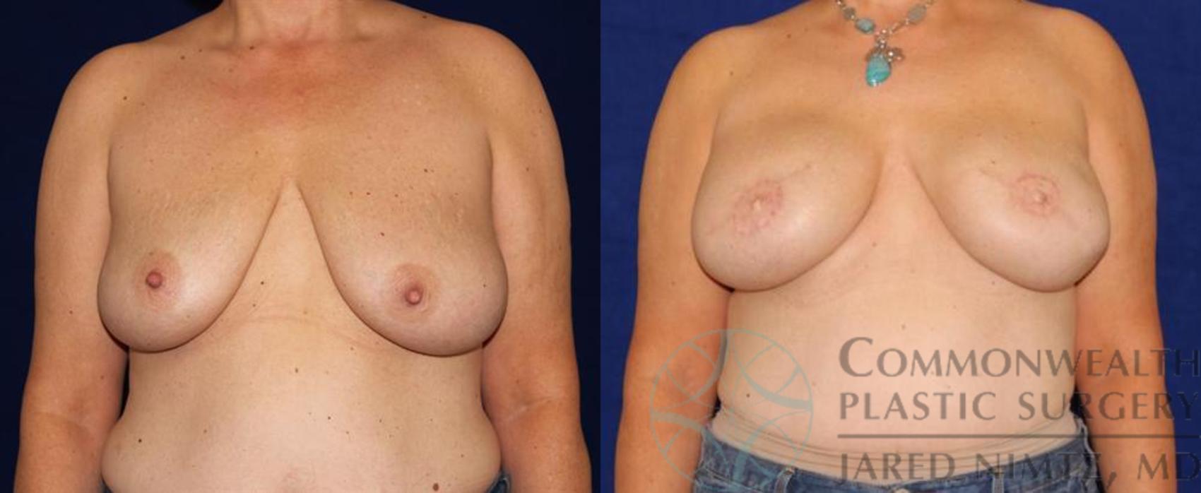 Breast Reconstruction Case 52 Before & After View #1 | Lexington & London, KY | Commonwealth Plastic Surgery