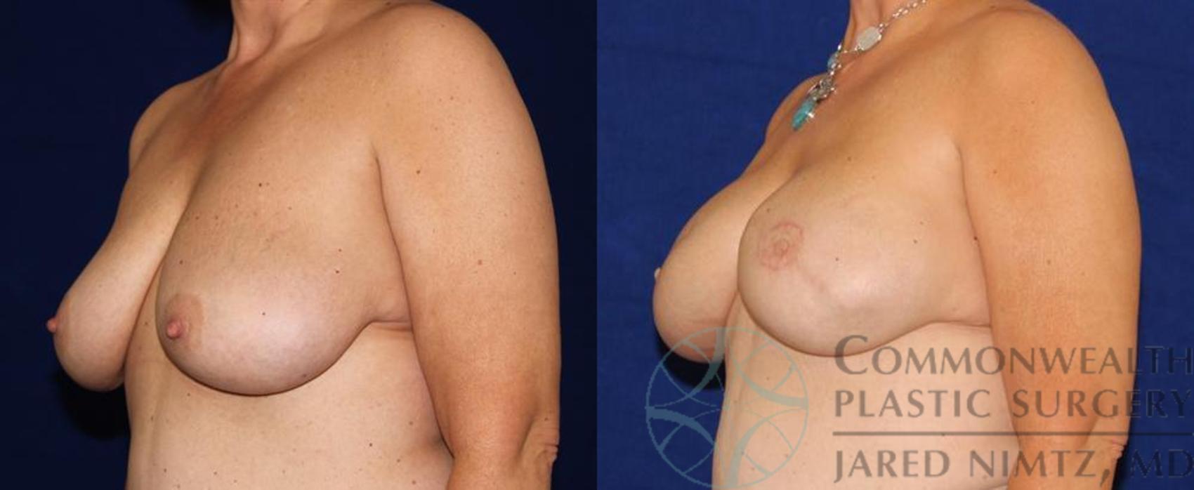 Before & After Breast Reconstruction Case 52 View #2 View in Lexington & Lousiville, KY