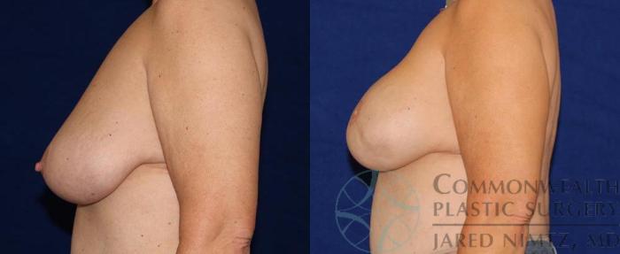 Before & After Breast Reconstruction Case 52 View #3 View in Lexington & London, KY