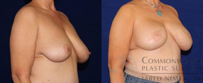 Before & After Breast Reconstruction Case 52 View #4 View in Lexington & London, KY