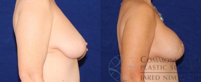 Before & After Breast Reconstruction Case 52 View #5 View in Lexington & London, KY