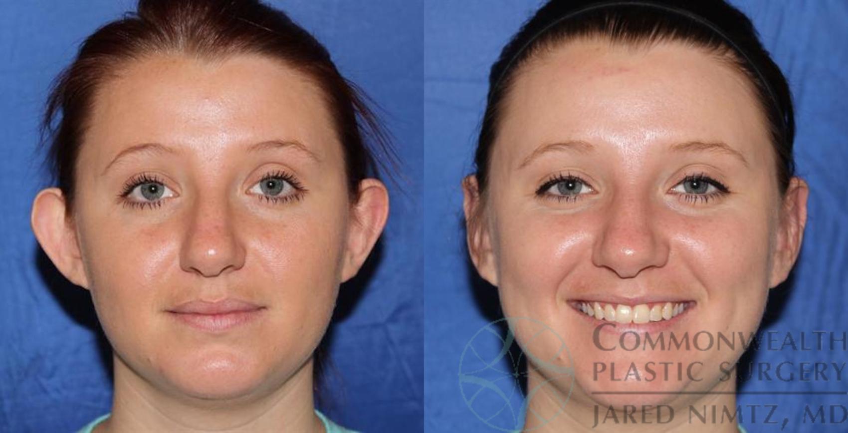 OTOPLASTY  JDT Plastic Surgery