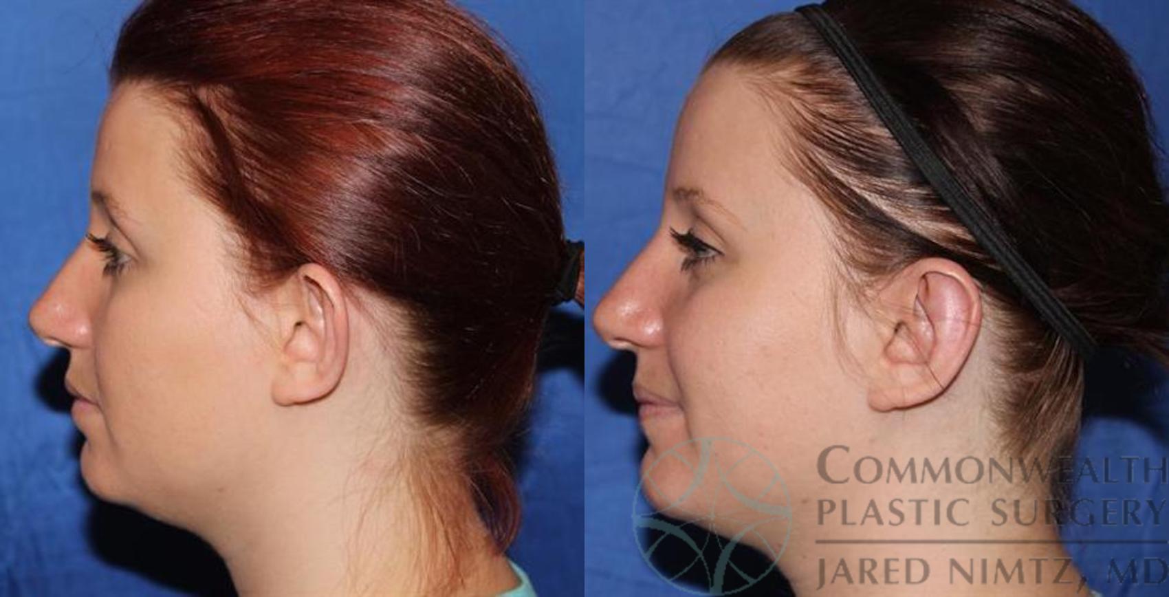 Otoplasty