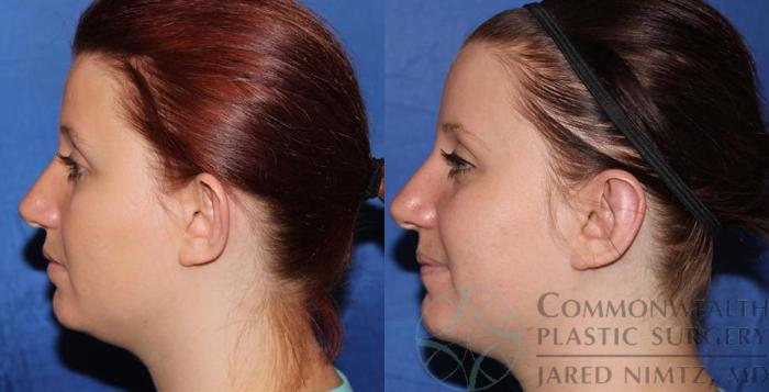 Before & After Ear Surgery Case 56 View #3 View in Lexington & London, KY