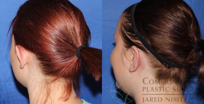 Before & After Ear Surgery Case 56 View #4 View in Lexington & London, KY
