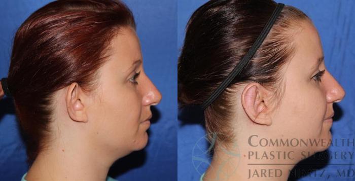 Before & After Ear Surgery Case 56 View #7 View in Lexington & London, KY