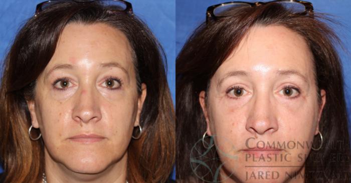 Before & After Eyelid Surgery Case 61 View #1 View in Lexington & London, KY