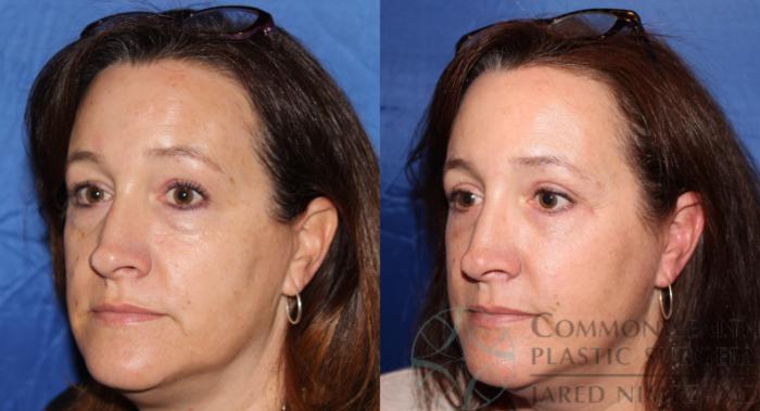 Before & After Eyelid Surgery Case 61 View #2 View in Lexington & London, KY