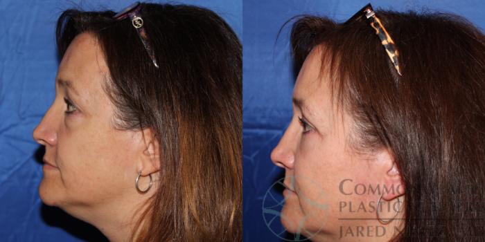 Before & After Eyelid Surgery Case 61 View #3 View in Lexington & London, KY