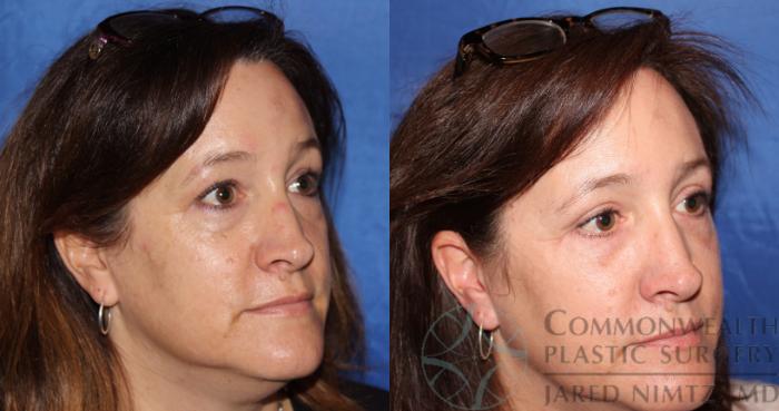 Before & After Eyelid Surgery Case 61 View #4 View in Lexington & London, KY