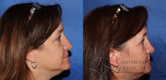 Before & After Eyelid Surgery Case 61 View #5 View in Lexington & London, KY