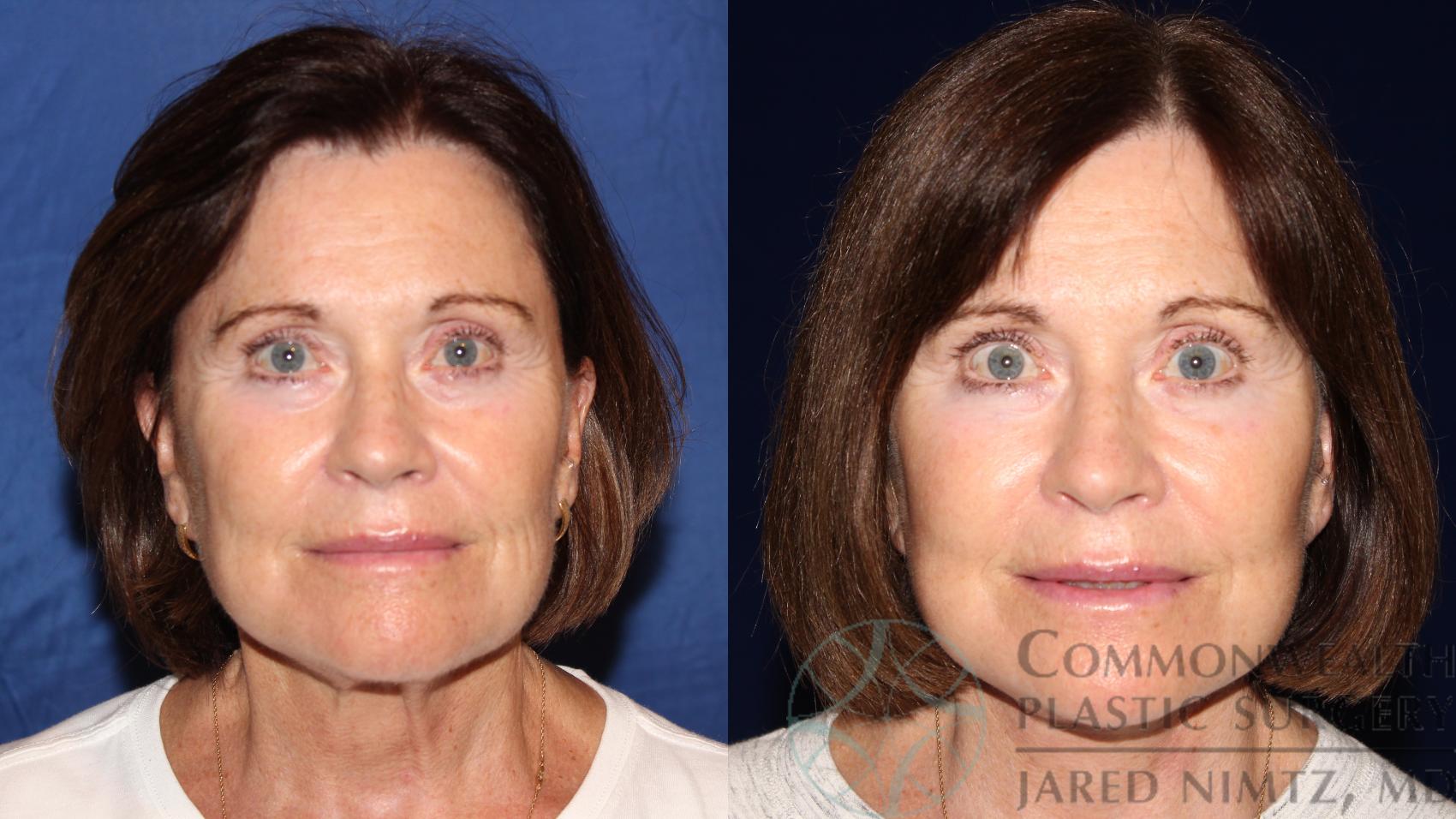 Before & After Facelift Case 119 Front View in Lexington & London, KY