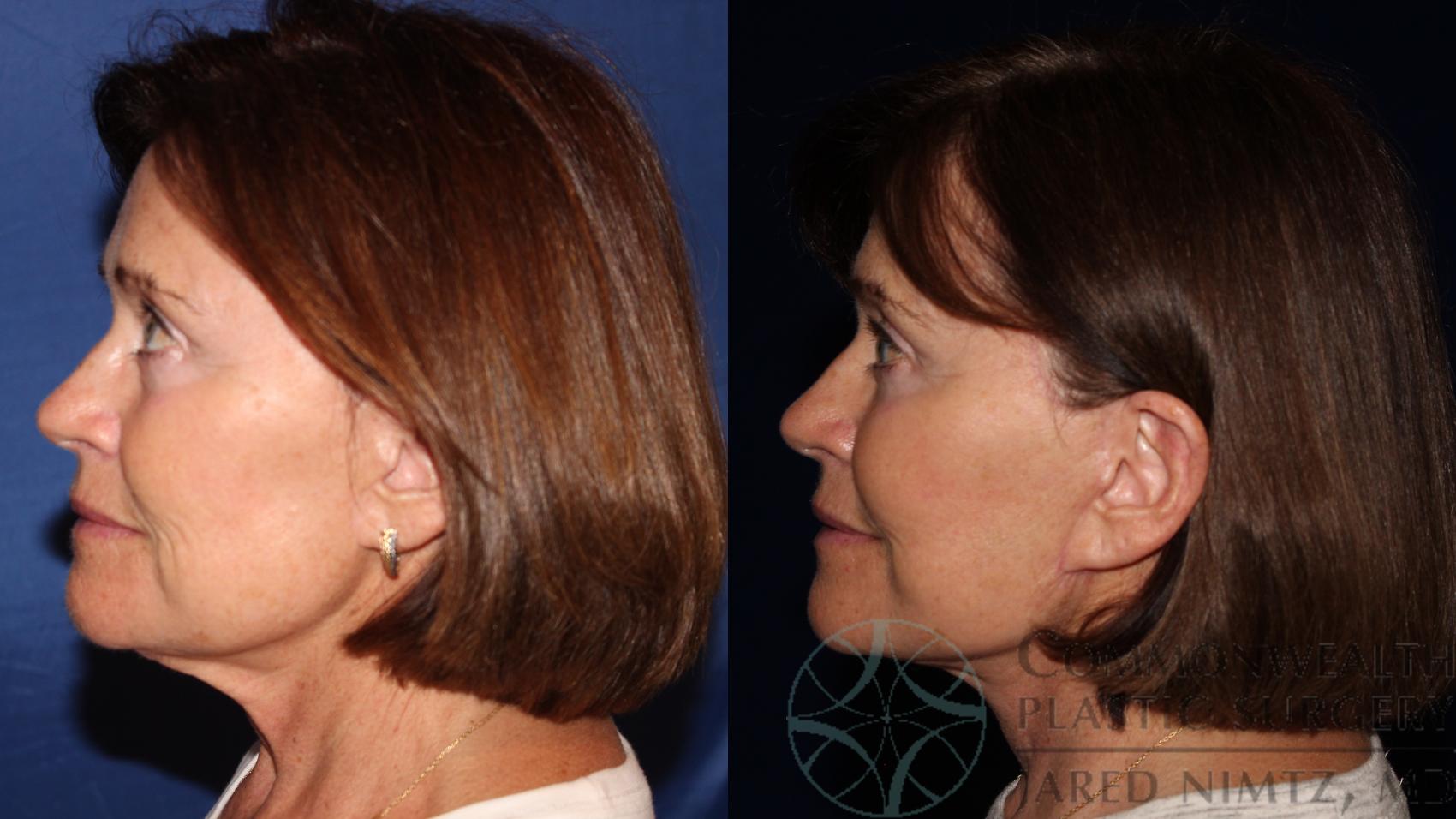 Before & After Facelift Case 119 Left Side View in Lexington & London, KY