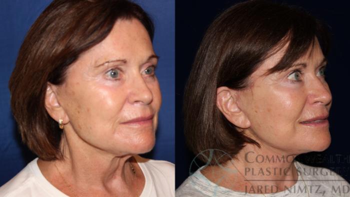 Before & After Facelift Case 119 Right Oblique View in Lexington & London, KY