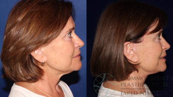 Before & After Facelift Case 119 Right Side View in Lexington & London, KY