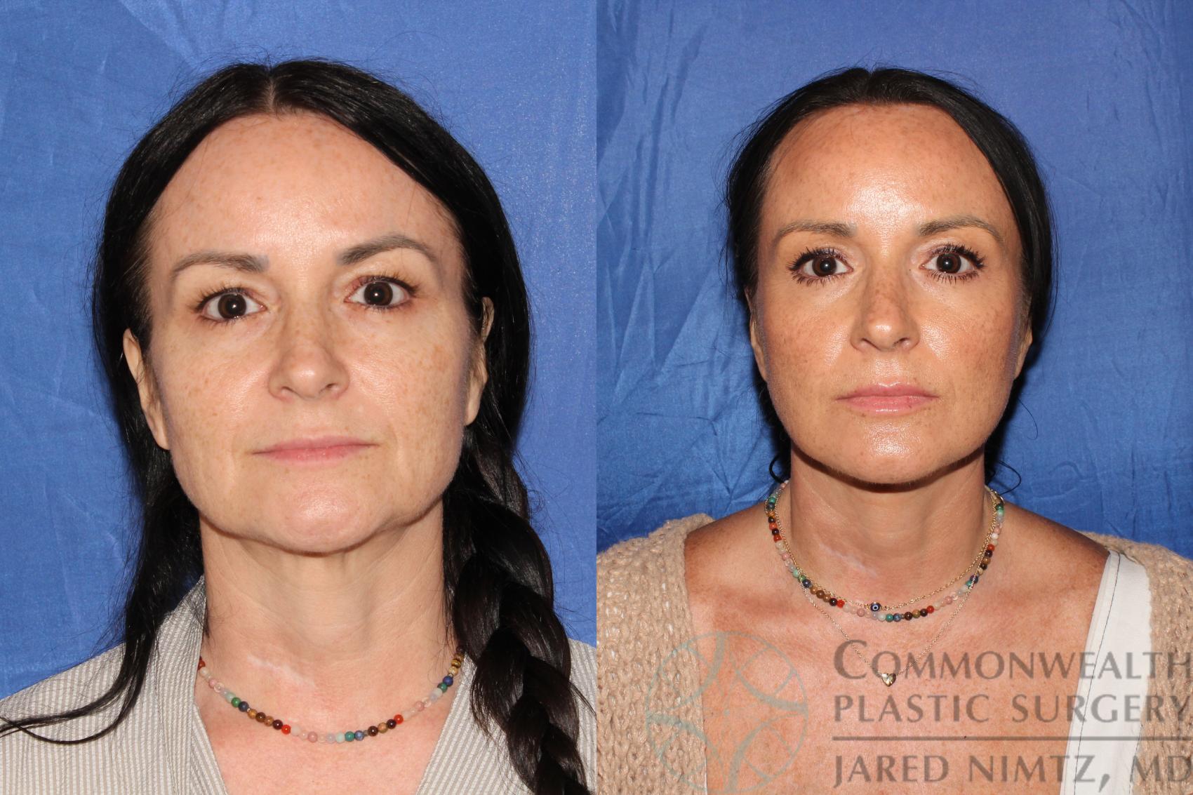 Before & After Facelift Case 124 Front View in Lexington & London, KY