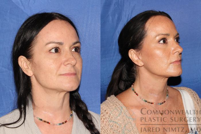 Before & After Facelift Case 124 Left Oblique View in Lexington & London, KY