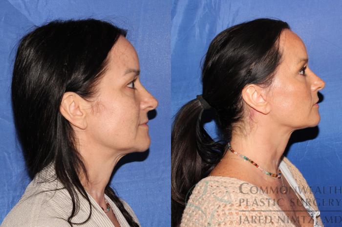 Before & After Facelift Case 124 Left Side View in Lexington & London, KY