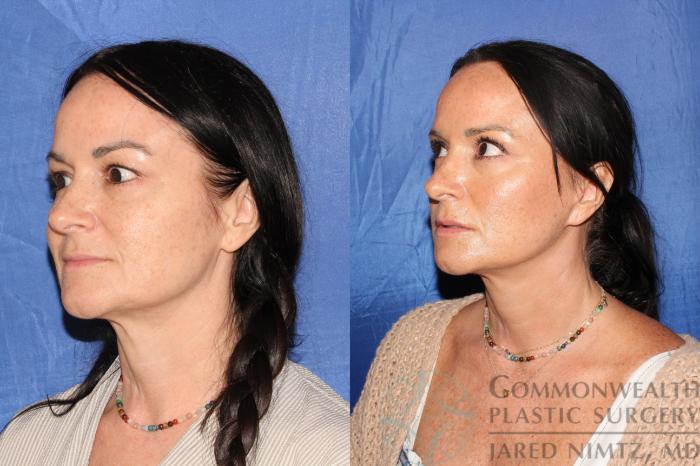 Before & After Facelift Case 124 Right Oblique View in Lexington & London, KY