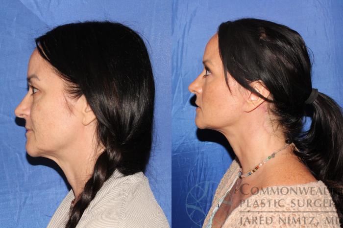 Before & After Facelift Case 124 Right Side View in Lexington & London, KY