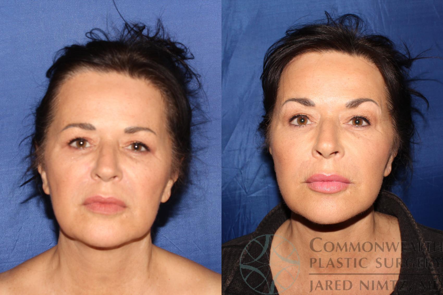 Before & After Facelift Case 125 Front View in Lexington & London, KY