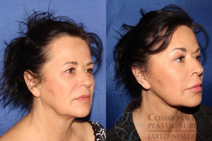 Before & After Facelift Case 125 Left Oblique View in Lexington & London, KY