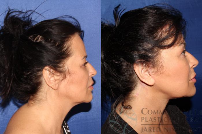 Before & After Facelift Case 125 Left Side View in Lexington & London, KY